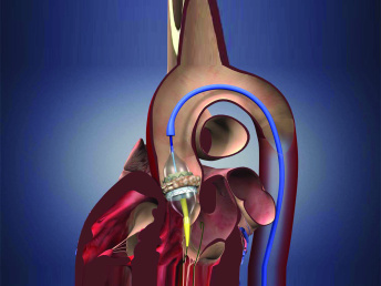Сложнейшие кардиохирургические операции TAVI успешно внедрены в практику Тюменского кардиоцентра