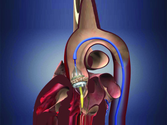 The most complicated cardiac surgeries: TAVI have been successfully introduced into practice in our Center