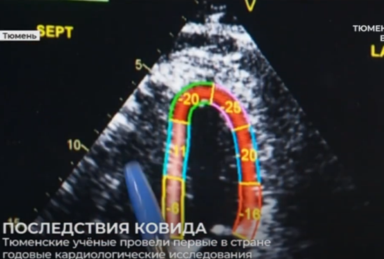 В отдаленные сроки после ковида у пациентов выявлены нарушения деформации сердечной мышцы. Телеканал "Тюменское время"